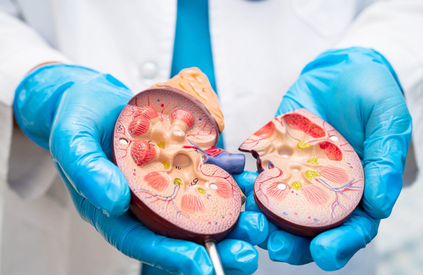 Kidney disease, Chronic kidney disease ckd, Doctor hold human model to treat and study in hospital.